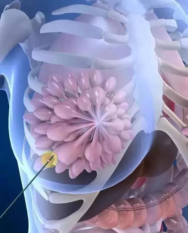 体检发现乳腺结节该怎么办一针消除病灶