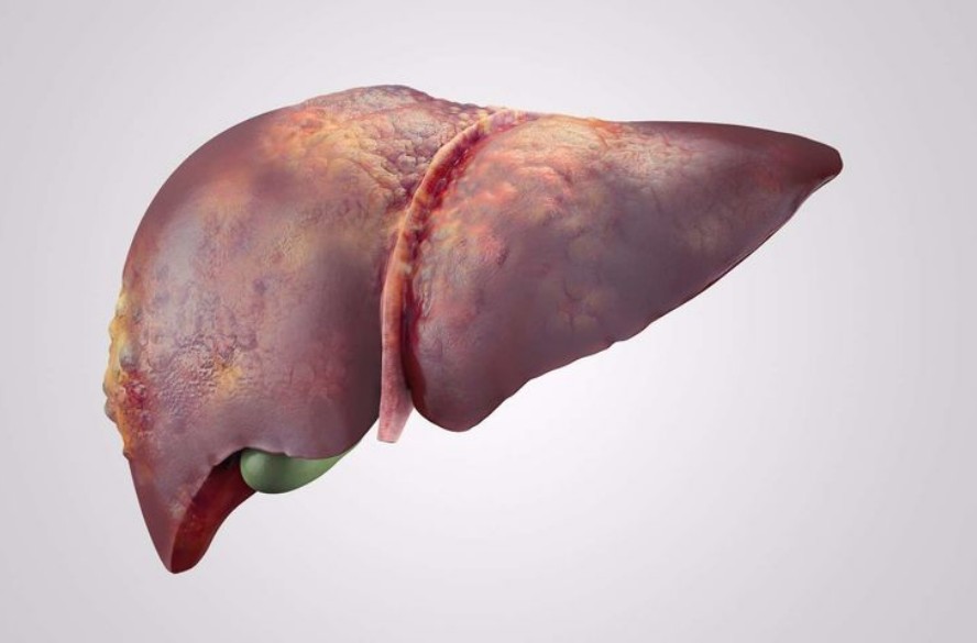 肝脏不好的信号,要记牢1,尿液颜色较深,不偏黄而偏棕,还伴有难以忍受