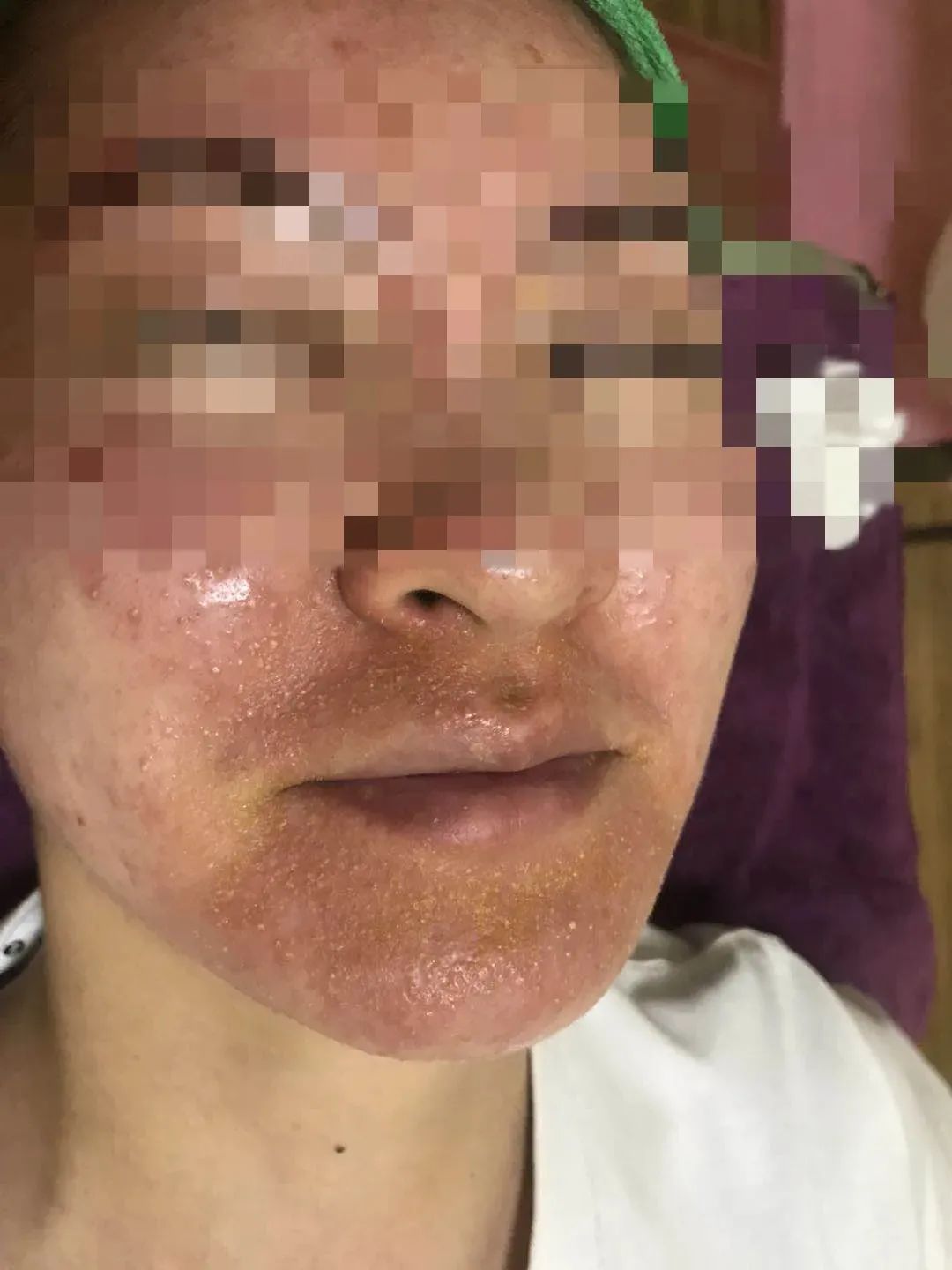皮肤鸦片杭州一妙龄女子停用美容院的这款产品后毁容了