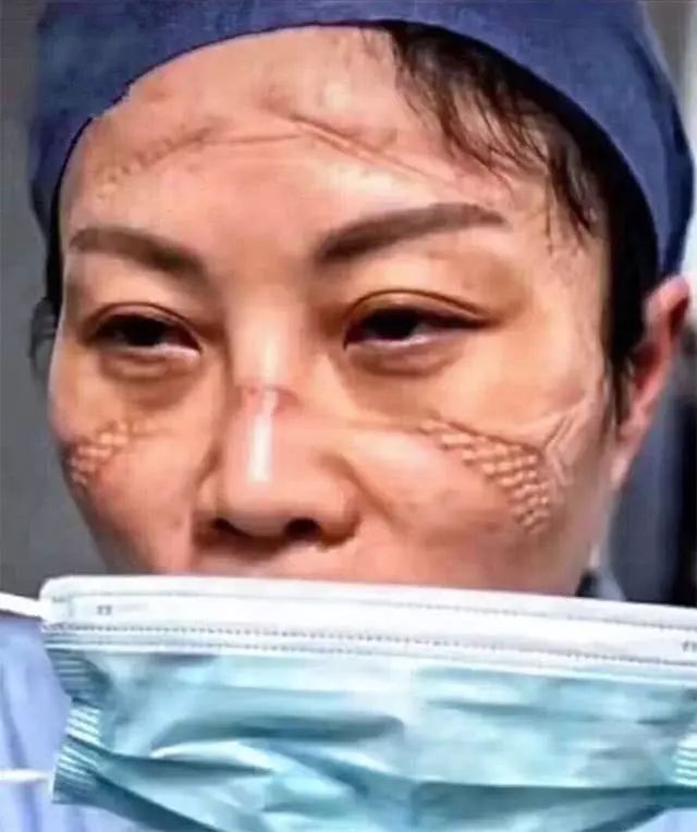 中国医生满脸勒痕照片被上传到国外网站后国外网友的评论亮了