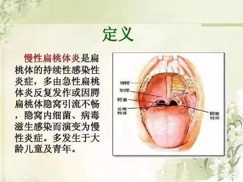 扁桃体肿大原因图片