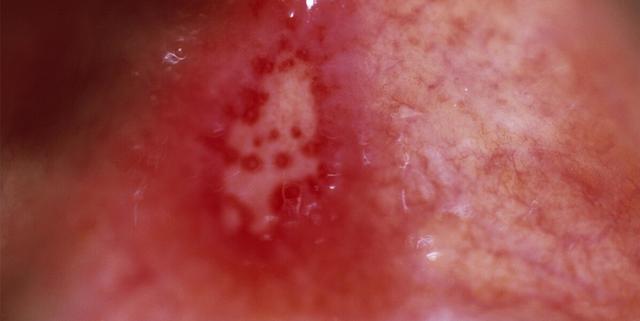 带状疱疹还会在嘴里出现,很多人会因此将其判定为口腔溃疡,以至耽误