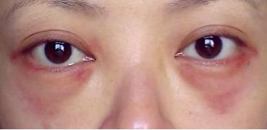 外切去眼袋二次去皮,外切去眼袋有后遗症吗,涨知识的时刻?__凤凰网