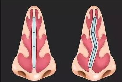 唇裂术后鼻畸形科普唇裂鼻中隔偏曲是怎么做手术的