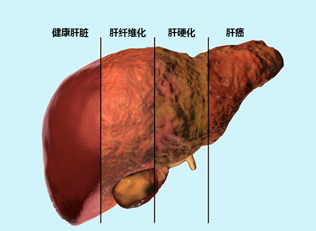 王安生:慢性乙肝病毒感染者约7000万例,人可以算命,但不可信命__凤凰