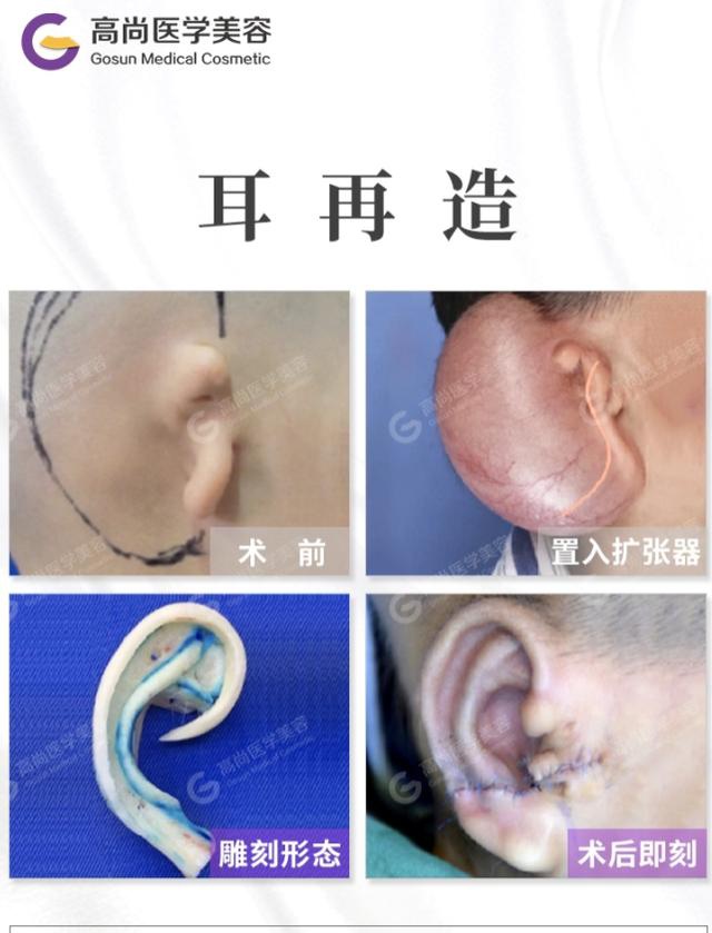 小耳畸形患者二期耳再造手术的术后恢复
