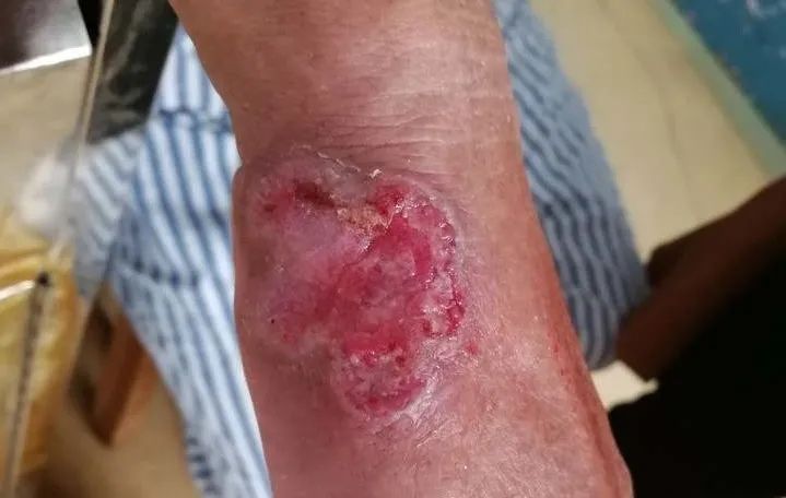 因手溃疡就诊的病人结果瘫了,三甲医院都没辙