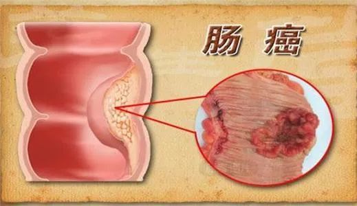 【專家答疑】大便帶血是痔瘡嗎?注意大腸癌的早期信號