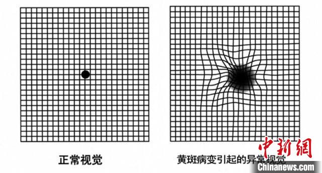 用阿姆斯勒表,自检时眼睛盯着注视点看,一旦发现直线变弯,方格扭曲,就