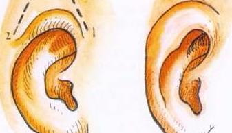 新生儿耳朵外轮廓畸形自己能变好吗