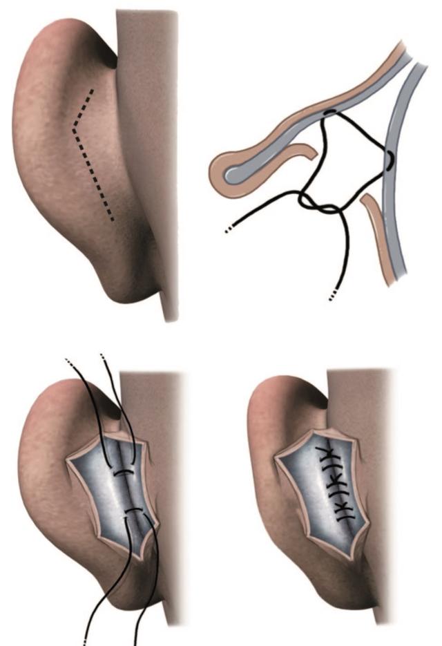 对耳轮成形良好,耳甲腔过深,做了