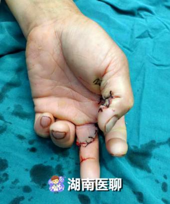 老师傅因手生不料锯断三个手指!医生:复工后安全问题不容小觑