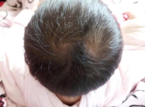 专家说头顶上旋的数量是由基因决定的,如果头发有两个生长中心就会