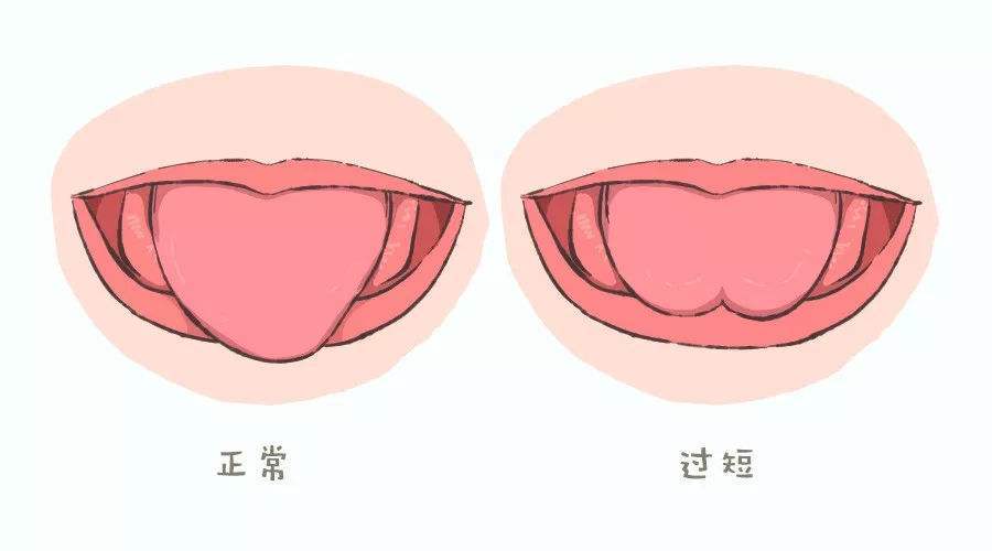 剪舌筋图片