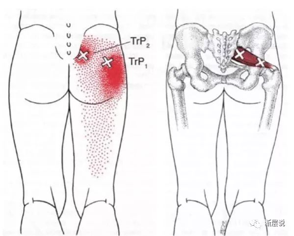 环跳穴腰痛必治臀息事又宁人