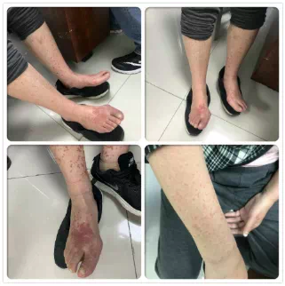 潇湘晨报|无故起了红色疹子是服药过敏吗？都是基因“惹的祸”