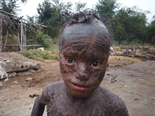 印度10岁男孩皮肤干燥像鱼鳞每月会脱落一次