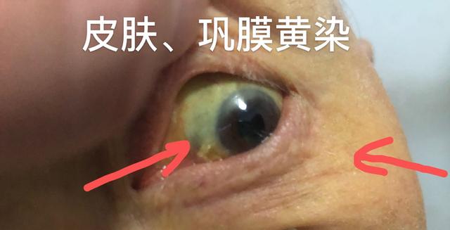 黄疸眼睛对照表图片