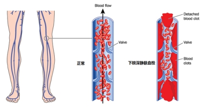 易被忽略的致命疾病:下肢静脉血栓栓塞