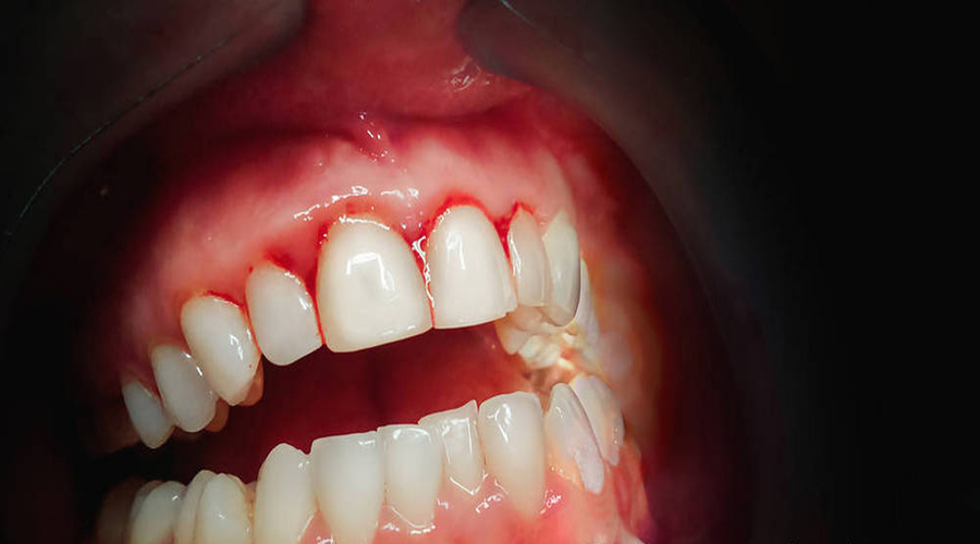 1,刷牙或咬硬物时牙龈出血