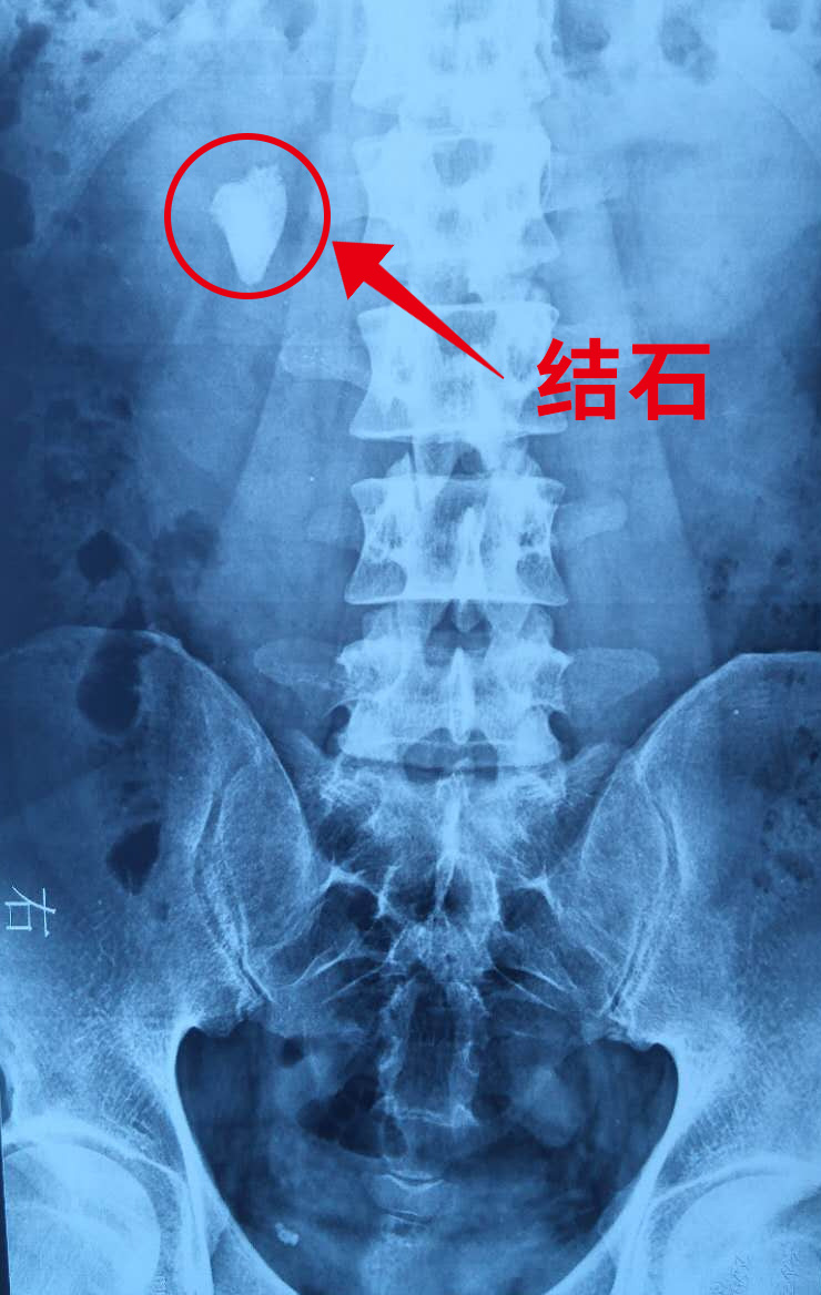图片说明:长在肾脏里的"宝石"型结石
