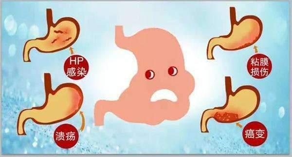 幽门螺旋杆菌 唯怕 此物 用于泡水 杀菌养胃护胃