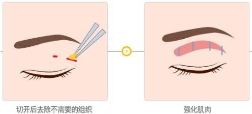 韩式双眼皮效果如何？与欧式双眼皮区别在哪？