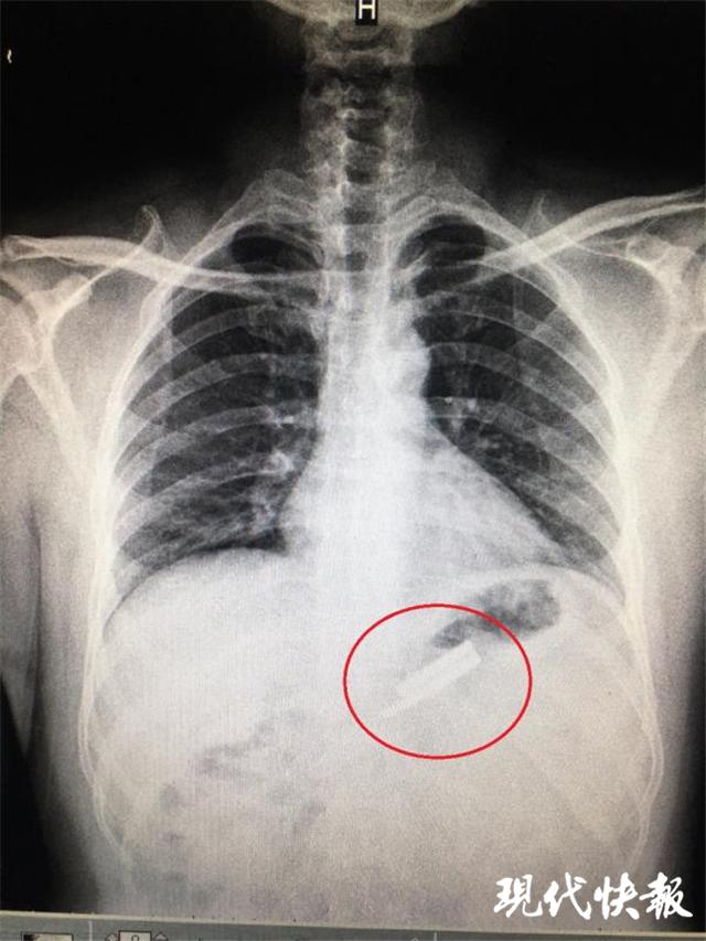 太狠了男子吞下2个刀片和2枚钢针