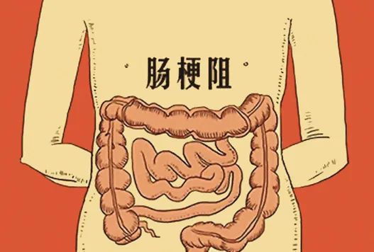 肿瘤患者肠梗阻怎么办？试试内科治疗的“6字方针”
