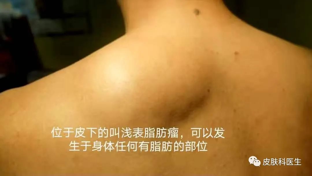 脂肪瘤的危害 凤凰网