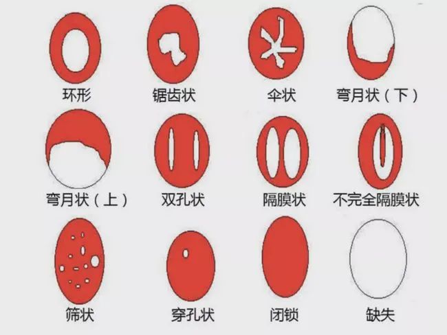 "处女膜"改为"阴道冠",因为它不是一片薄膜,而是阴道口组织的弹性皱褶