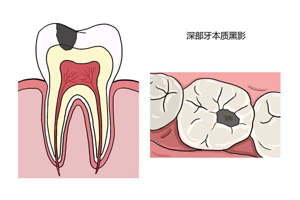 牙齿蛀牙，要如何判断龋齿严重程度！ 凤凰网