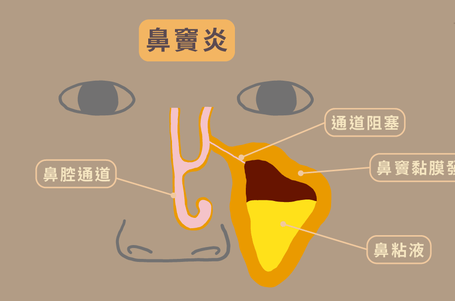 北京首大鼻科陳潛導致67鼻竇炎復發的原因有哪些