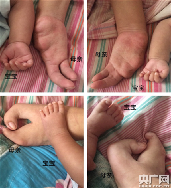 跨越世纪的牵手遗传性手足裂患者生育健康宝宝郑大一附院生殖与遗传