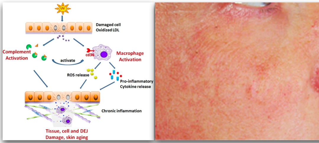 都是由於外界環境破壞了正常細胞結構,導致 細胞 損傷,皮膚炎症和衰老