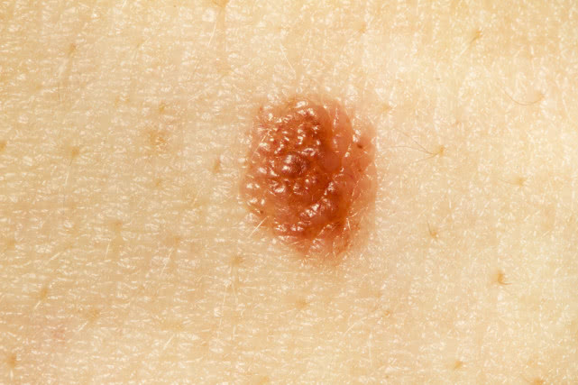 有人说,出现"1痛2痣3黄",是肝癌正"蓄势待发"!你怎么看?__凤凰网