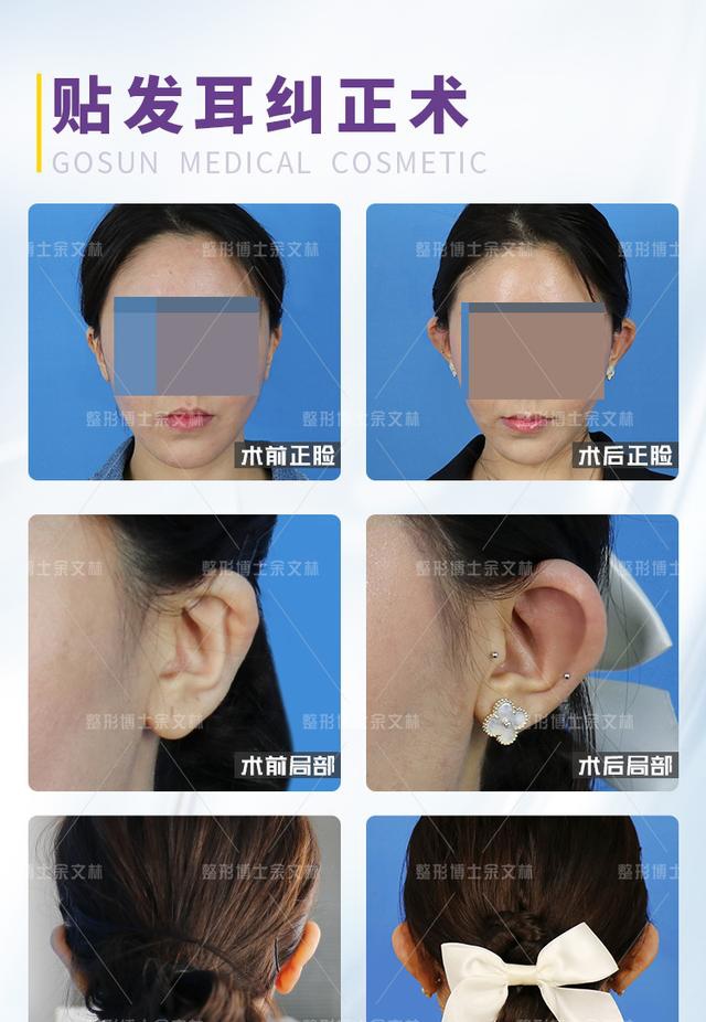案例分享贴发耳有救了患者矫正后的双耳超灵气