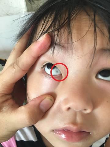 孩子白眼球有黑斑图片