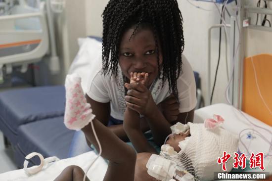 三次手术 罗马医院历时一年分离连头女婴