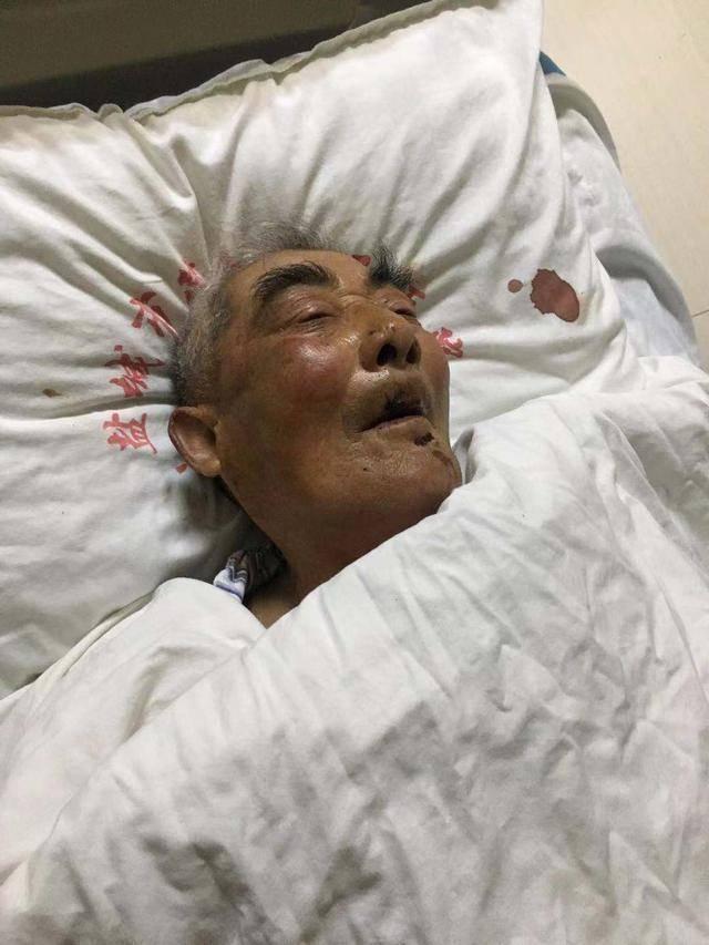 被紧急送进医院,当时李老汉已经处于昏迷状态,医生闻到老人家浑身酒气