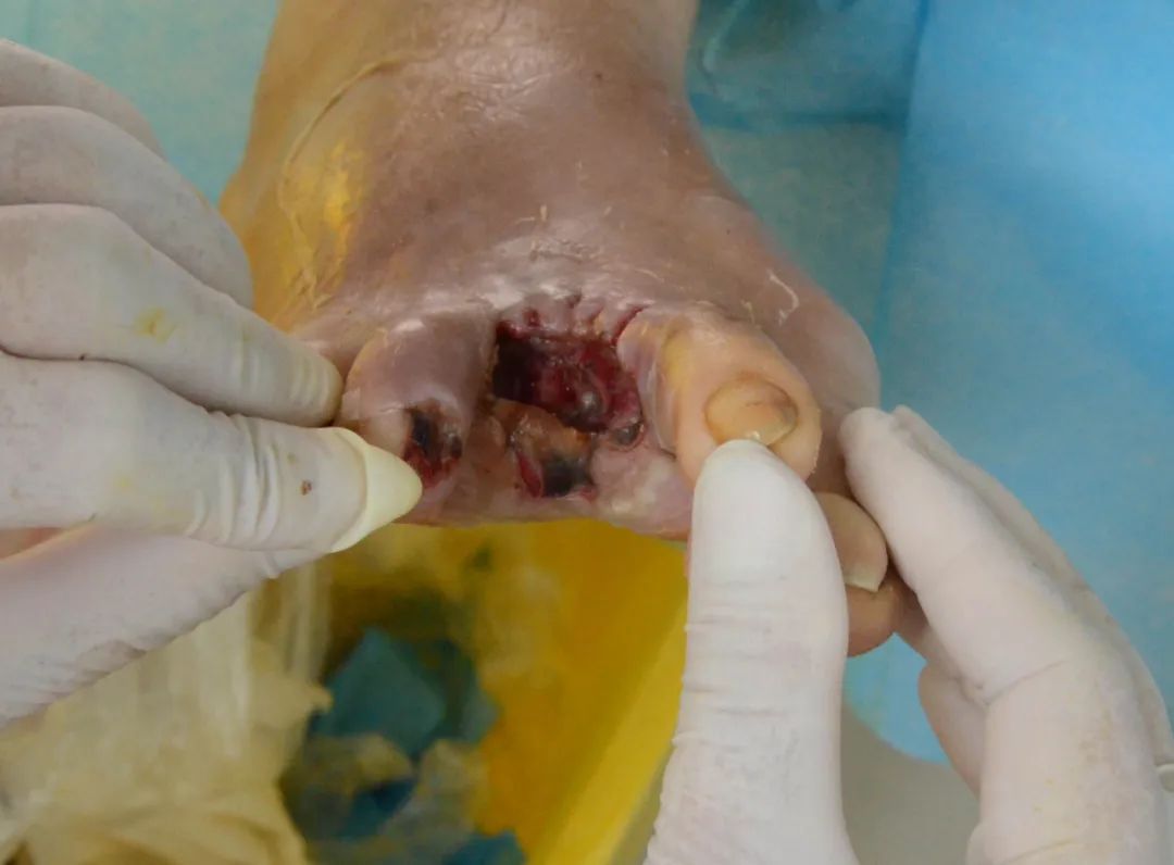 截趾?植皮?专科,专病,专治,让糖尿病足患者免截肢