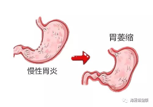 慢性胃炎的分类与高危人群__凤凰网