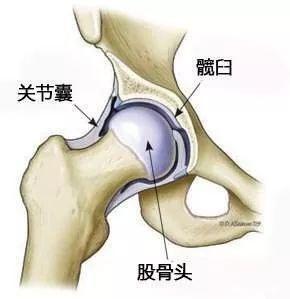 股骨頭壞死是什麼原因引起的髖關節活動受限就是股骨頭壞死