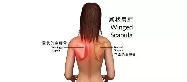 背部肩胛骨凸起 不是性感蝴蝶骨 是种病 真正的美背这样练 凤凰网健康 凤凰网 背部肩胛骨凸起 不是性感蝴蝶骨 是种病 真正的美背这样练 凤凰网健康 凤凰网