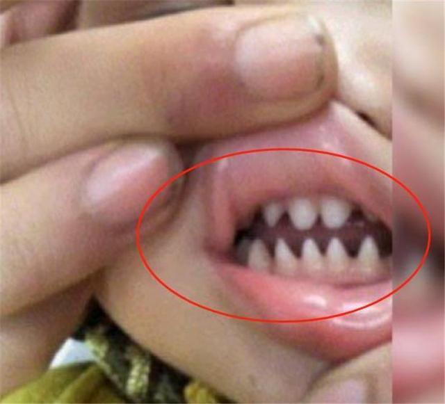 林女士开始没在意,觉得让孩子坚持刷牙就不会影响牙齿健康,但最近孩子