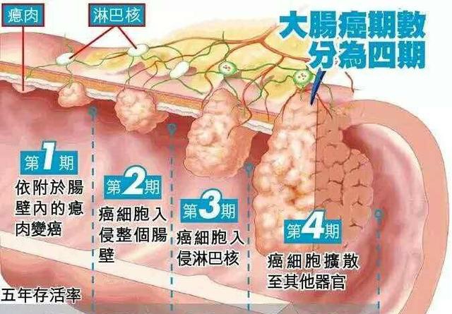 低位直腸癌手術要不要選擇保肛式