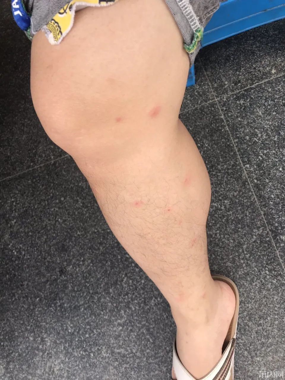 浙江小伙湖边走了一圈双腿被咬成这样最近多人中招但