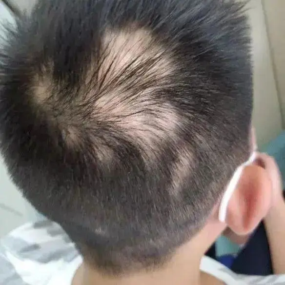 十几岁男孩因课业压力大头秃,父母给予期望太大反而害了孩子