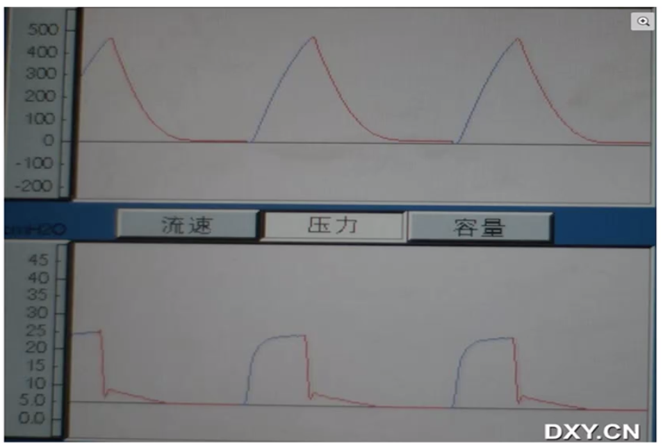 5 种常见呼吸机异常波形 一文教你调节参数 凤凰网健康 凤凰网