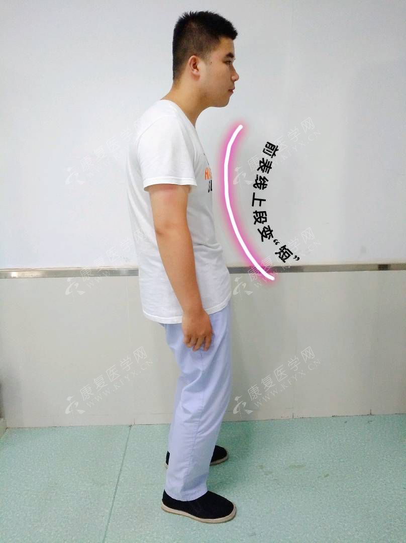 如何通过姿势评估前表线和筋膜问题？（附手法治疗）__凤凰网